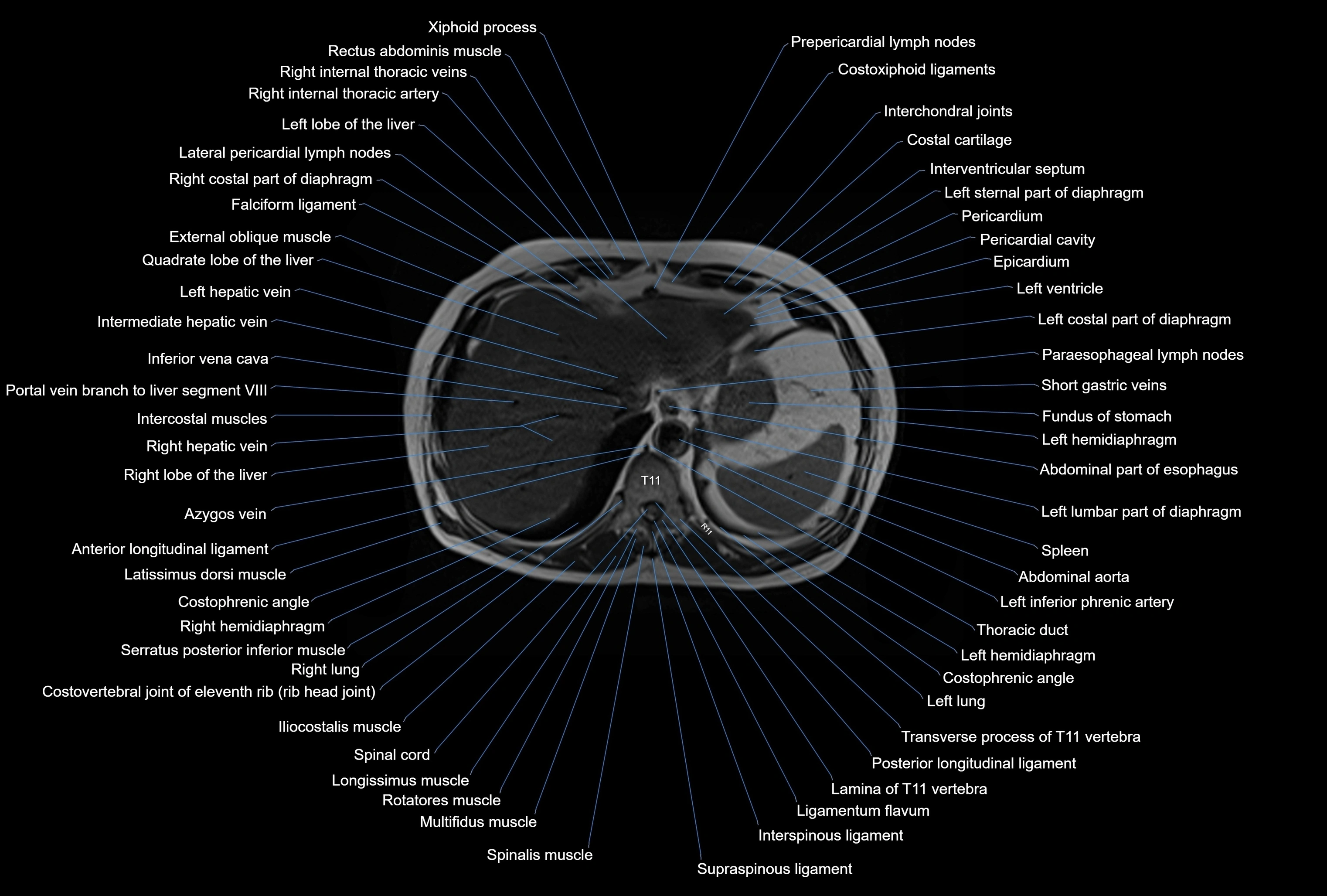 MRI Abdomen axial cross sectional anatomy radiology  image-img-00001-00007.webp